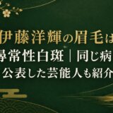 伊藤洋輝の眉毛は尋常性白斑｜同じ病を公表した芸能人も紹介